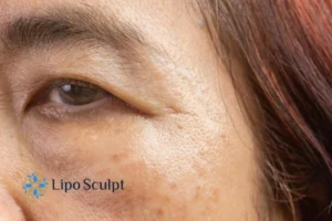 Cryopen: The Revolutionary Treatment for Age Spots Unveiled 2 Are age spots Stanley giving you low self esteem? Contact us today!
