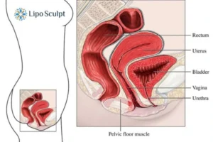 Treatment For A Leaky Bladder 2 How EM Chair treatment Stanley can help Leaky bladder issues. Read more now!
