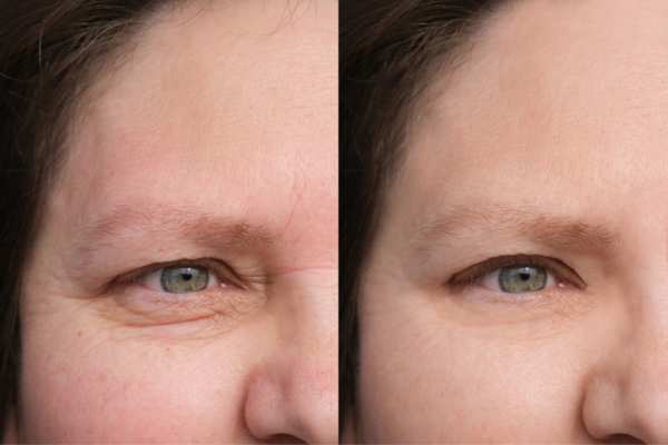 HIFU vs Botulinum Toxin: Understanding the Differences 4 How long do HIFU results last Stanley?